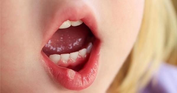 Biểu hiện của bệnh viêm loét miệng lưỡi 1