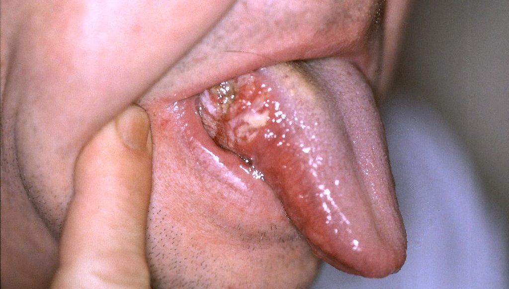 Nhận biết bệnh ung thư lưỡi 1