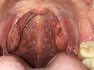 hình ảnh viêm họng hạt 4