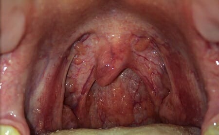 hình ảnh viêm họng hạt 5