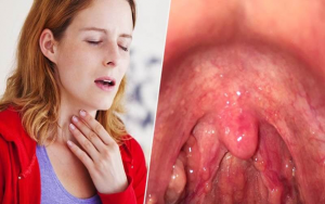 Phân biệt viêm họng cấp tính và mạn tính như thế nào? 1 Phân biệt viêm họng cấp tính và mạn tính như thế nào? 1